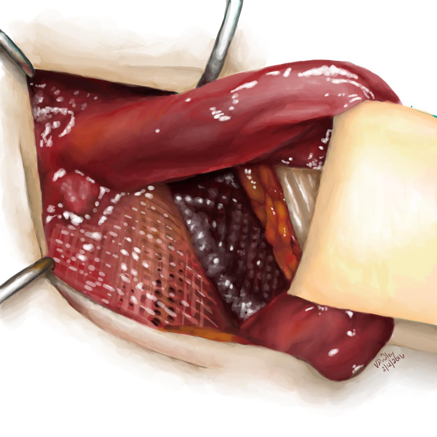 Inguinal hernia patch Inguinal hernia patch